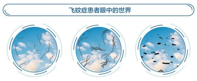 产品用多了会得“飞蚊症”？尊龙凯时人生就是搏平台电子