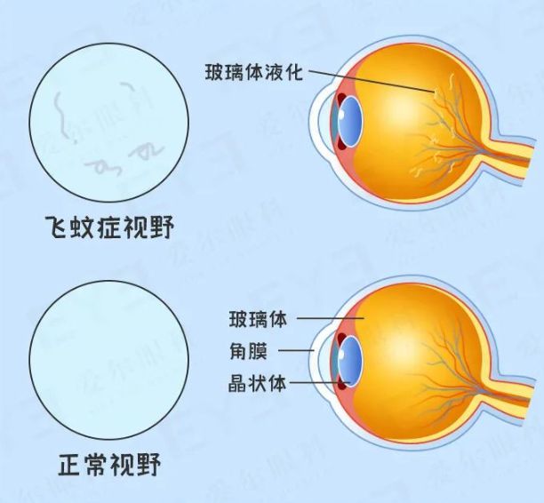 产品用多了会得“飞蚊症”？尊龙凯时人生就是搏平台电子(图2)