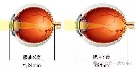 】高度近视人群这几条内容务必知道！尊龙凯时人生就是搏平台【爱眼小课堂(图5)